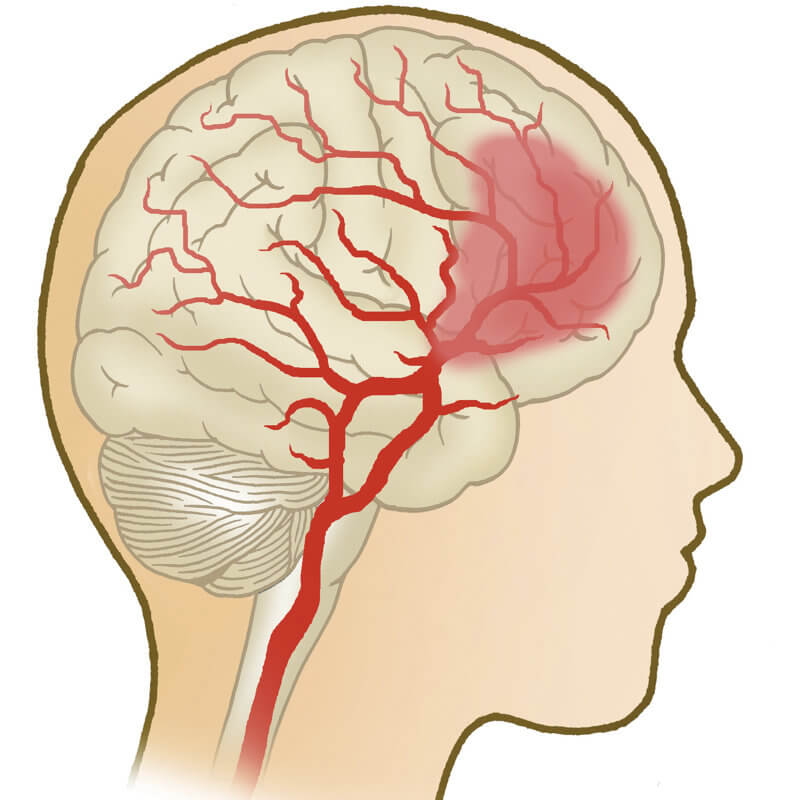 VSVZ81SI-zvisan-krvni-tlak-Krka-okvara-mozganov-c800x800